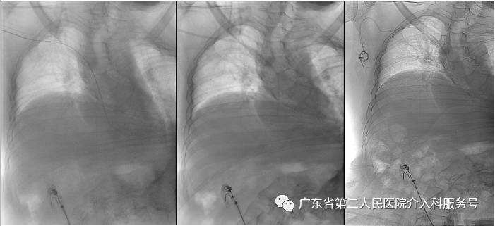 输液港能多次做吗,输液港可以重复使用吗