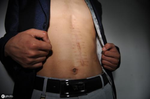 多大的肾结石需要做手术？除了多喝水，这些方法也能帮助排出结石