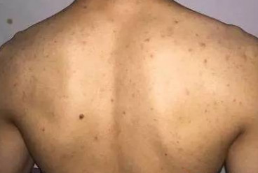 男性背后长疙瘩红红的是什么原因,背后和胸前长红点是什么原因