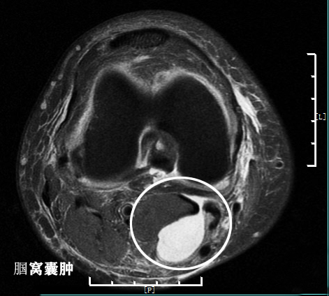 怎样能看懂膝关节核磁图片,如何看懂膝关节磁共振报告