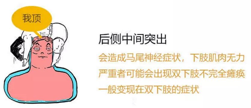 腰间盘突出别发愁记住3个技巧,专家告诉你腰间盘突出该怎么解决
