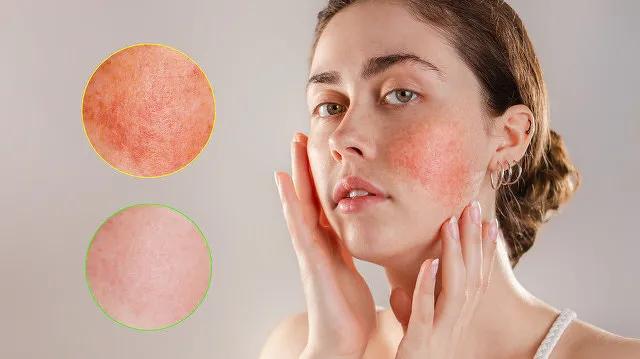 换季敏感肌的最佳治疗方法,五秒钟帮你解决敏感肌