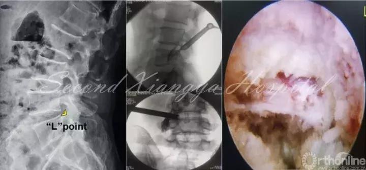 经皮腰椎间盘切除术有何优缺点,什么是经皮内镜腰椎手术