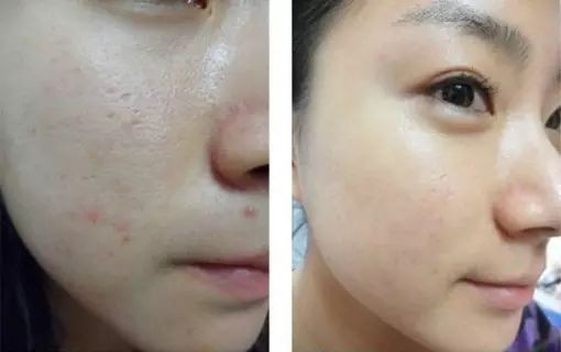 水光针究竟靠不靠谱,水光针究竟怎么选