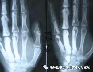 蜡泪样骨病能治愈吗,蜡泪样骨病什么意思