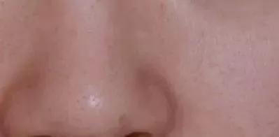 听说你毛孔大到可以放芝麻，该怎么办？