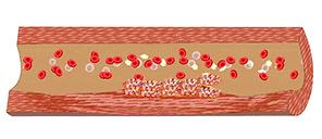 血管堵塞动态图片,血管疏通动图