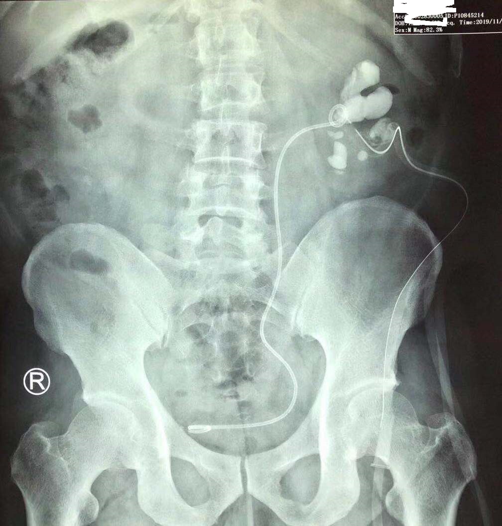 疯狂的石头碎石,疯狂的石头包世宏结石