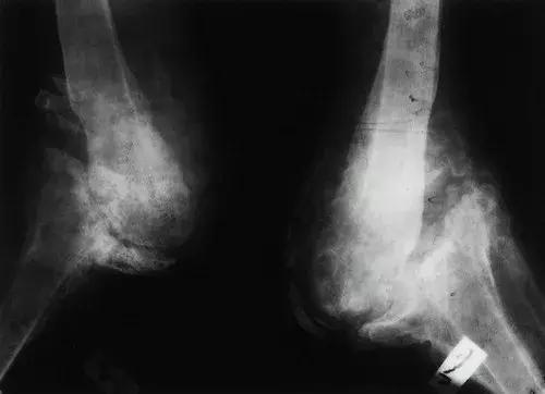 神经性骨关节病,神经性关节炎症状图片