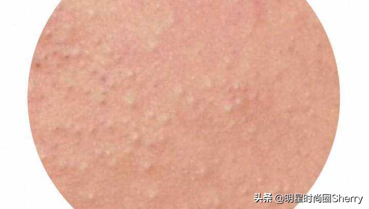 痘痘闭口粉刺去除的小妙招,痘痘粉刺闭口如何快速去除