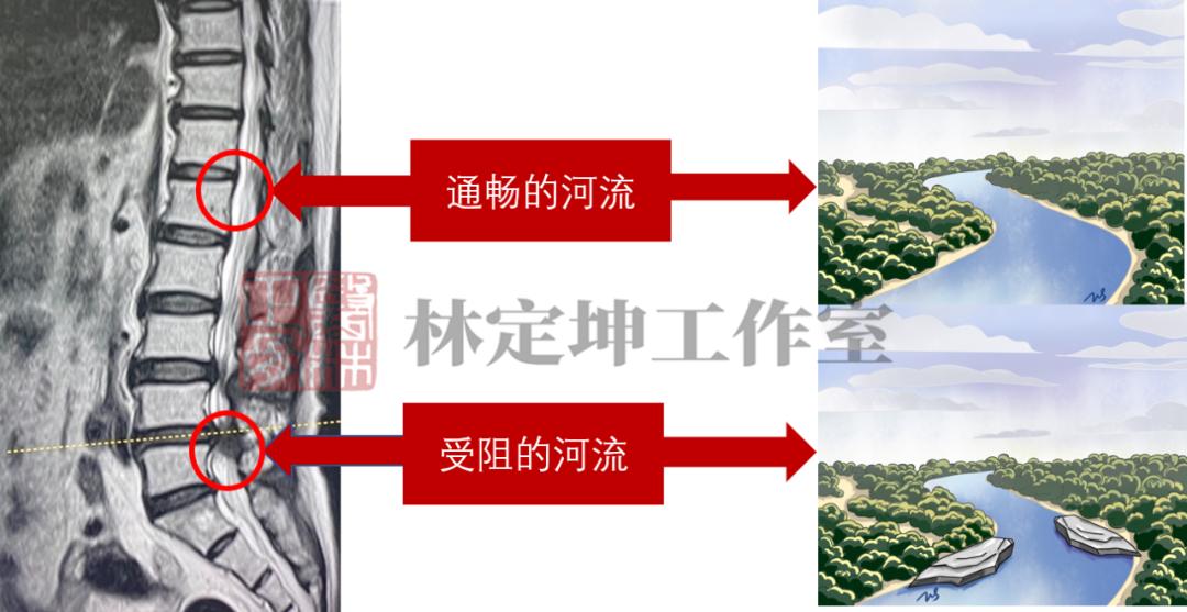 中医中药治腰椎管狭窄有什么办法,如何缓解腰椎管狭窄带来的腰腿疼