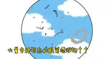 有飞蚊症眼睛睁开一瞬间有黑点,飞蚊症是黑色的圈圈吗