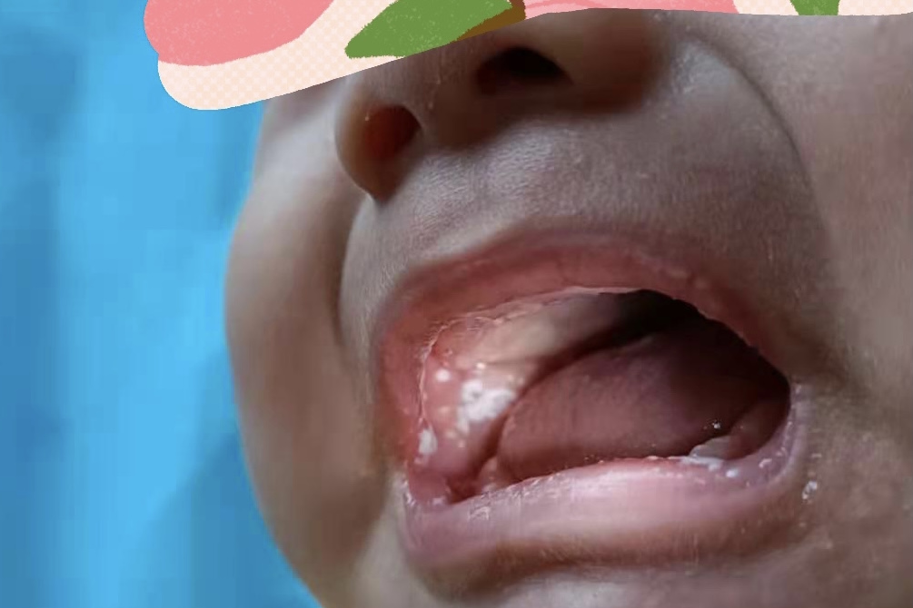 「雪口病」宝宝嘴里有“棉絮”，根本擦不掉