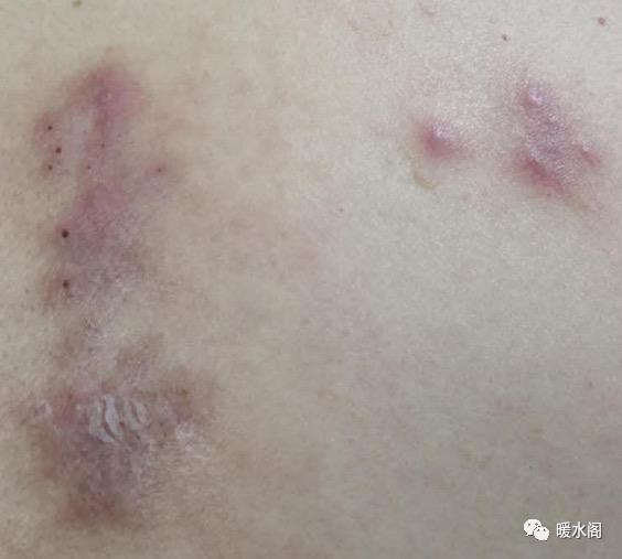 皮肤疱疹神经痛,皮肤烧灼感带状疱疹