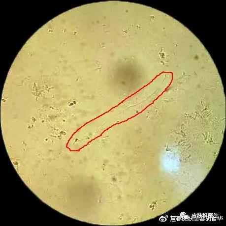 是不是皮肤癣，皮肤真菌镜检来告诉你！