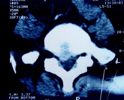 腰椎间盘突出你了解吗,腰椎间盘突出症的科普问答