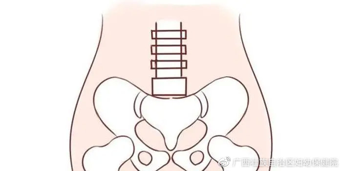 健康科普堂分娩镇痛细节决定成败,怀孕骨盆疼痛一招搞定