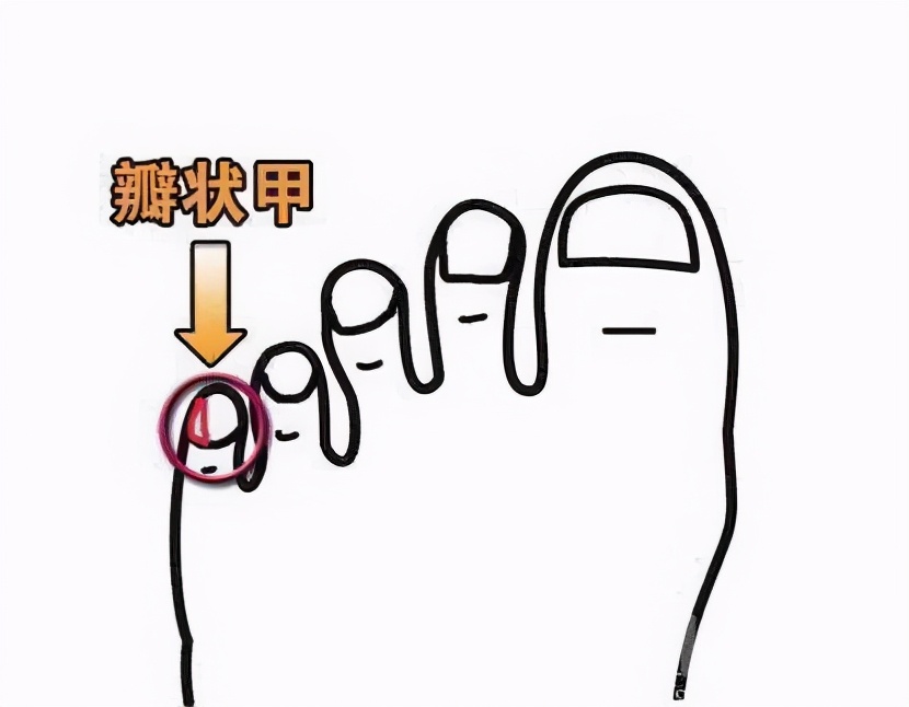 小脚趾甲两瓣一定是汉族人么,小脚趾甲一瓣的人是什么民族