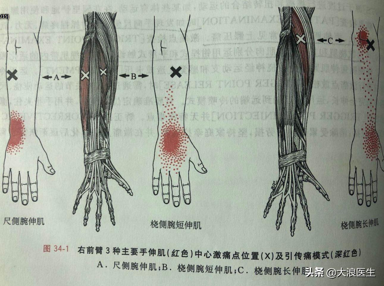 抱孩子抱出妈妈手，腱鞘炎怎么办？手把手教您解决