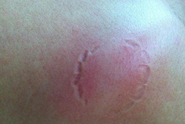 乙肝患者被狗咬了打狂犬针有用吗,被乙肝病人咬破要打什么疫苗