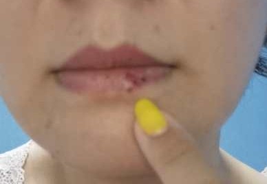 治咽痛三味药,治口腔疱疹