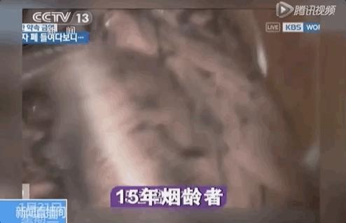 打开死者的肺，才明白有3亿人，在悄悄花钱买死