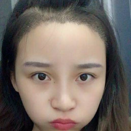 植发后取发区多久恢复正常,三级脱发植发能恢复到原来吗