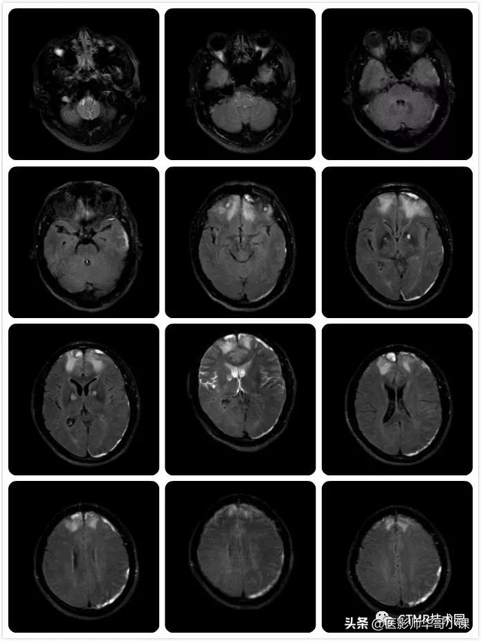 「MRI技术」磁共振伪影分析,了解下SSh_FLAIR序列
