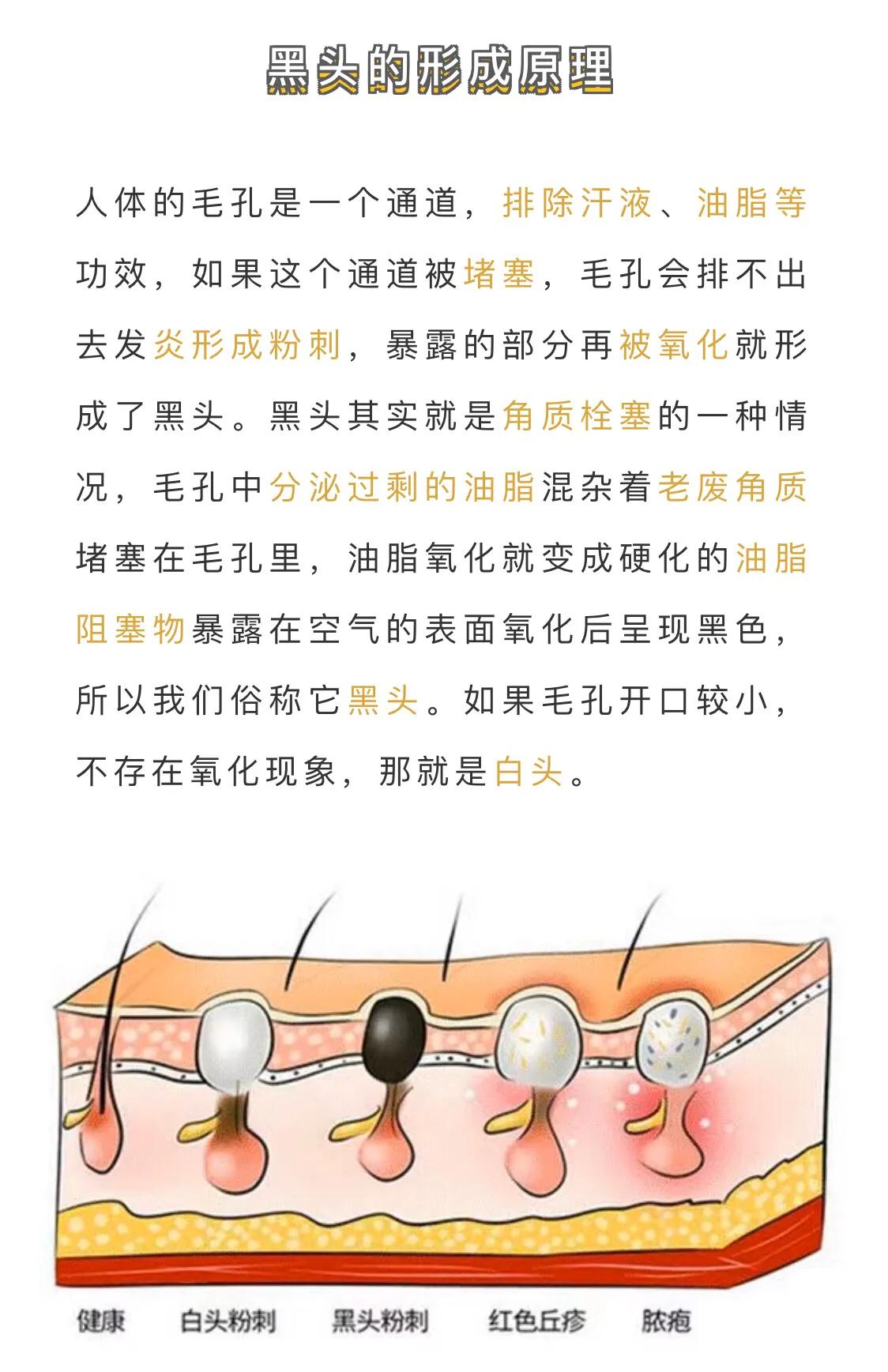 有黑头困扰你应该明白这几件事,黑头到底有没有方法改善