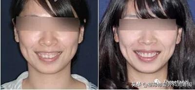 瘦脸针刚打完脸会不会比之前要大,打完溶脂针瘦脸针有一边脸僵了