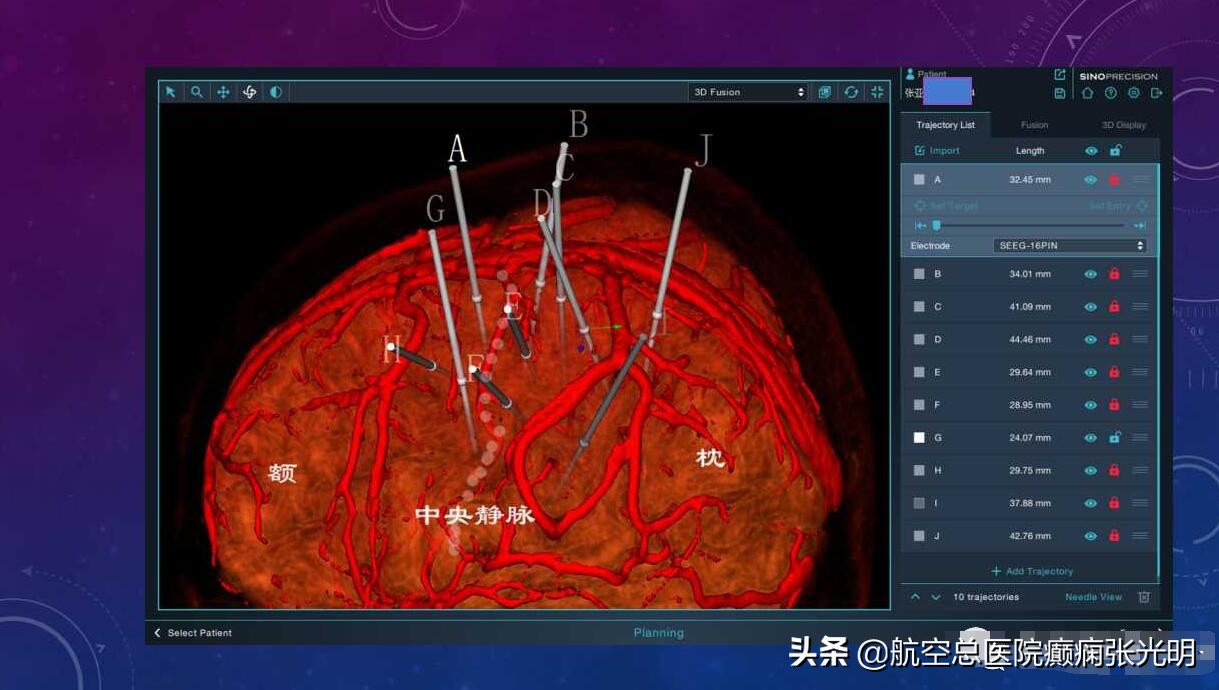 张光明左颞叶癫痫手术成功率,张光明谈治疗癫痫的方法有哪些