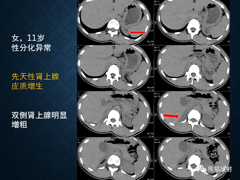 纵隔和肾上腺恶性肿瘤,纵隔性肿瘤位置图
