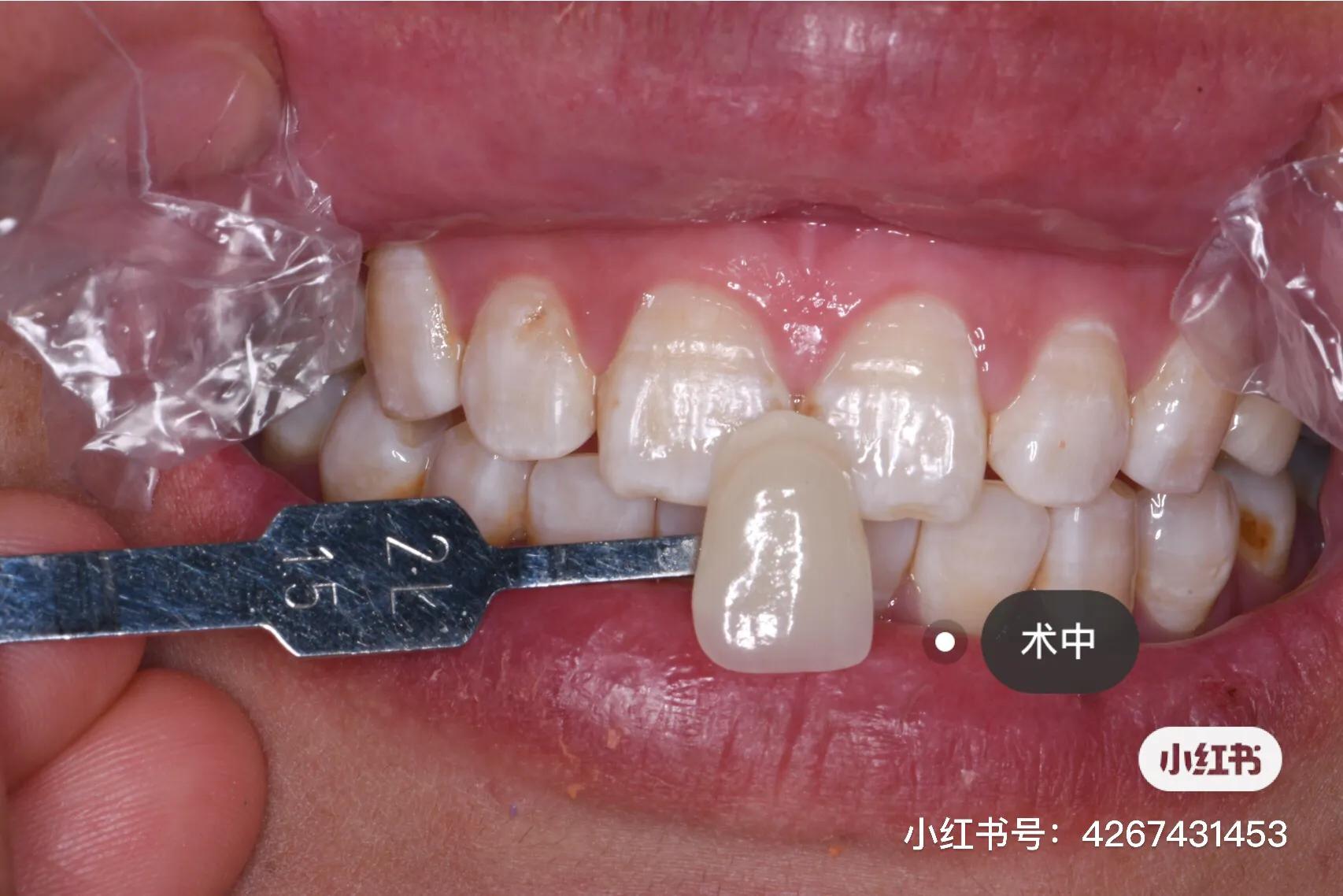 断牙修复,断牙修复病历