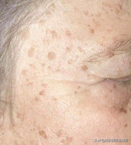 中药点斑好还是激光祛斑好,脸上有斑打激光过后吃有讲究吗