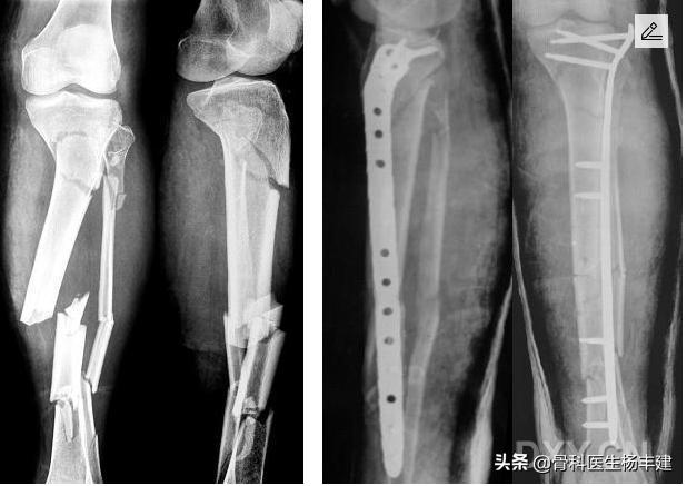 锁骨骨折后钢板断裂怎么办,股骨骨折钢板断裂原因分析
