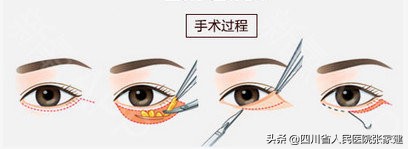 去眼袋手术各种后遗症怎么处理,祛眼袋手术有后遗症吗危险吗