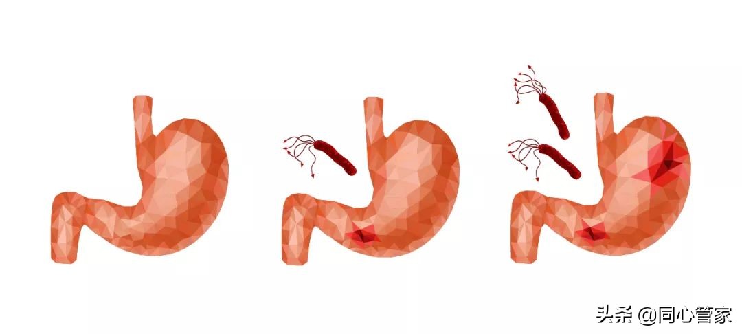 吃阿司匹林伤胃了有解药吗,吃阿司匹林对胃伤害怎么办