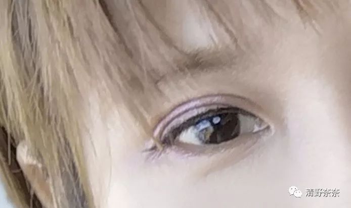 四十岁有法令纹川字纹医美项目,法令纹和鱼尾纹用医美怎么处理