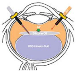王方教授：严重硅油乳化眼手术处理一例