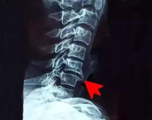 威灵仙和楮实子治骨刺使用方法,治脚骨刺方法