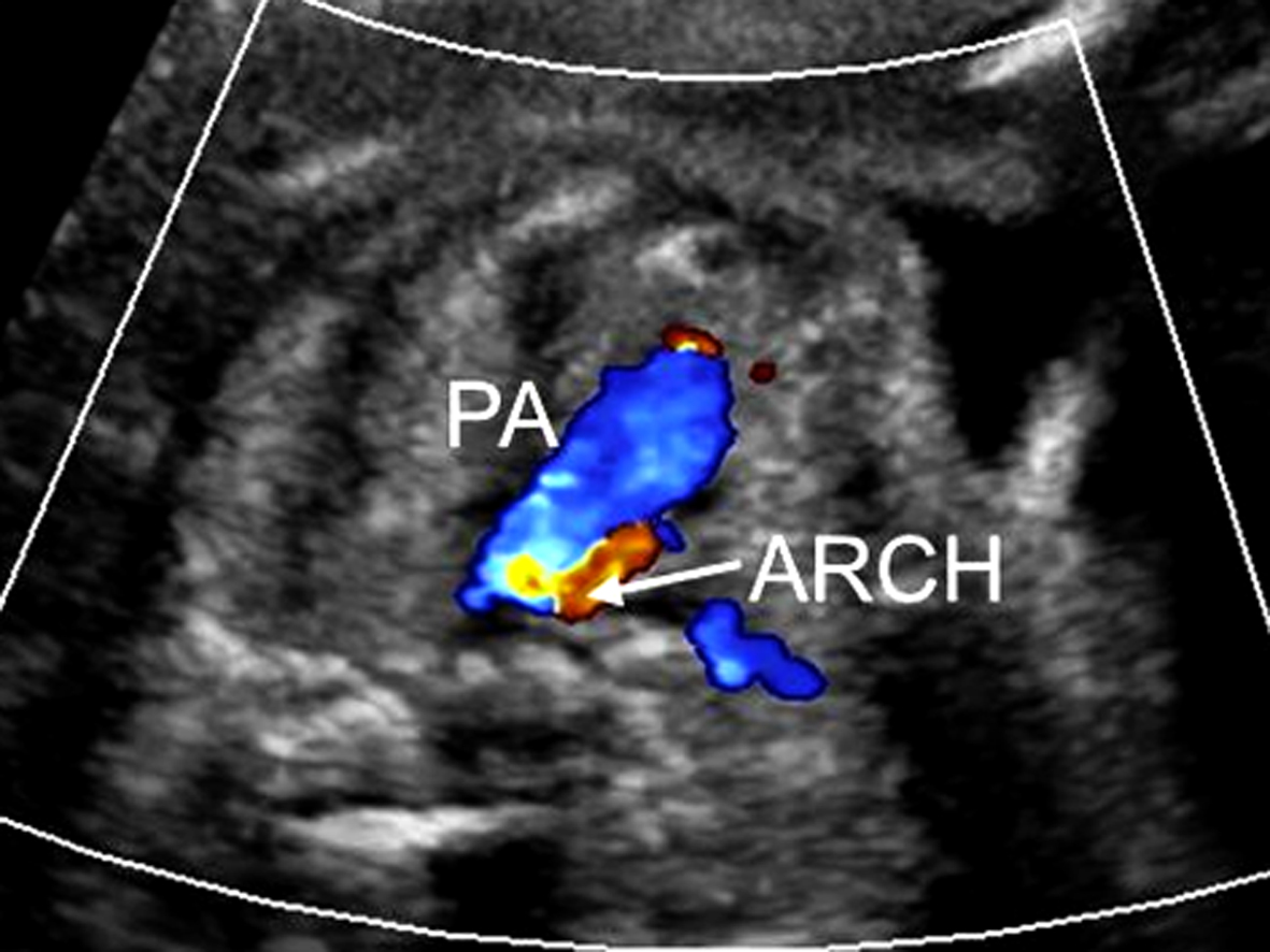 明明白白做超声26-4：胎儿心脏解剖结构异常-心室发育异常