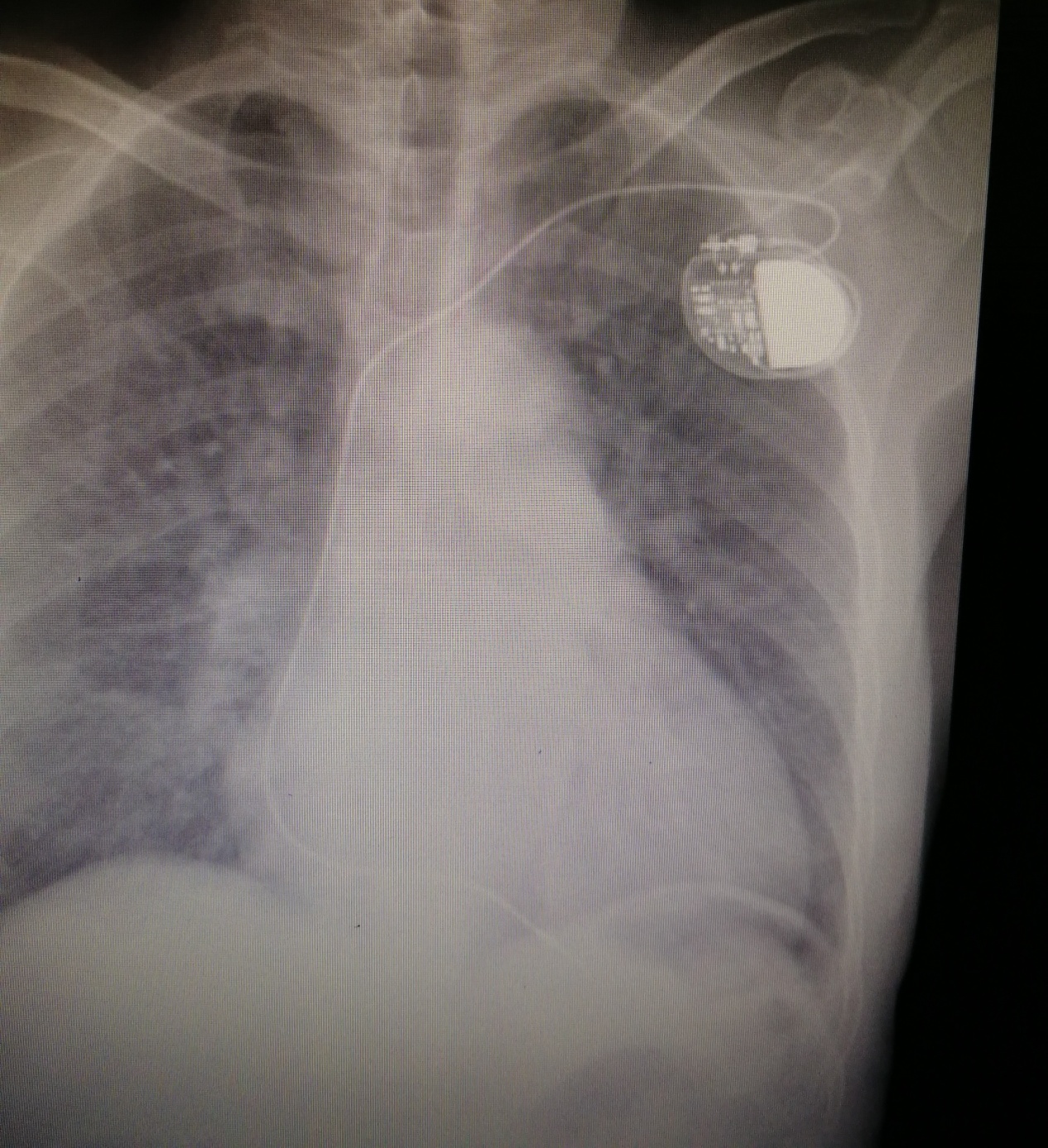 我院心内科援外医生完成圣普首例超声引导下永久心脏起搏器植入术