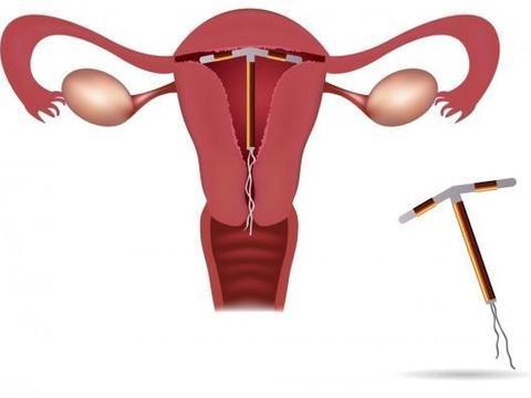 生完孩子到底要不要上环？上环的这几个副作用宝妈要知道