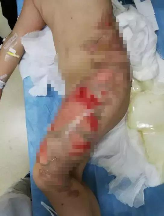 苏州科技城医院烧伤整形科｜谨防烧烫伤，变成一个更美好的你