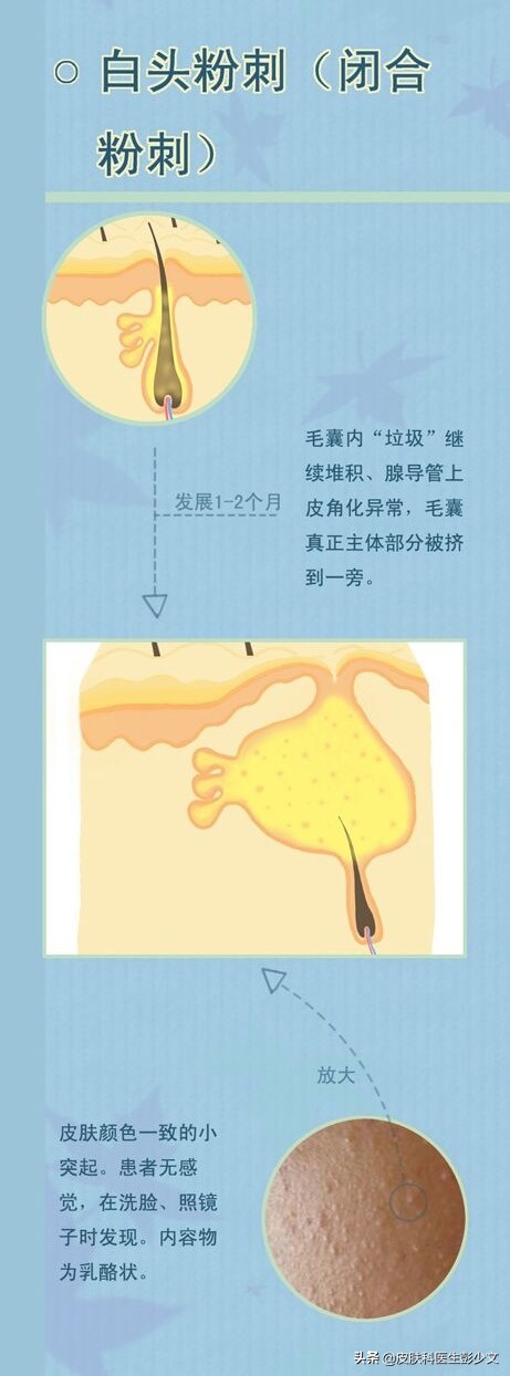 连续十年不停的长痘疮是怎么回事,身上长痘疮怎么治疗