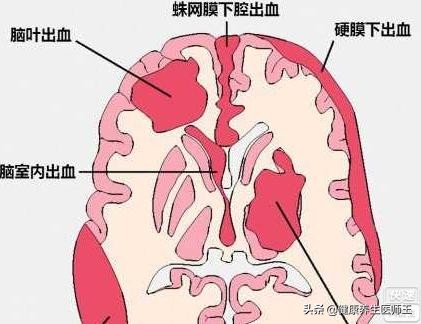 脑出血生命之缘,生命缘脑出血纪录片