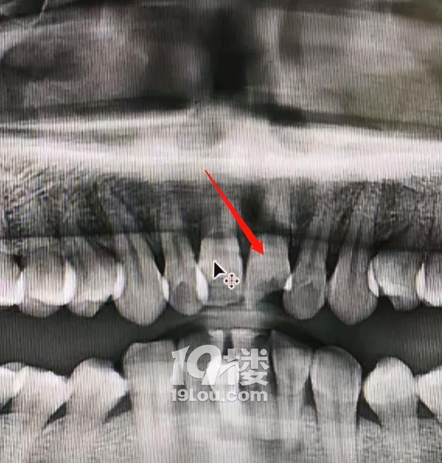 玻璃门撞碎划伤人责任划分,顾客撞门玻璃鼻子受伤谁的责任