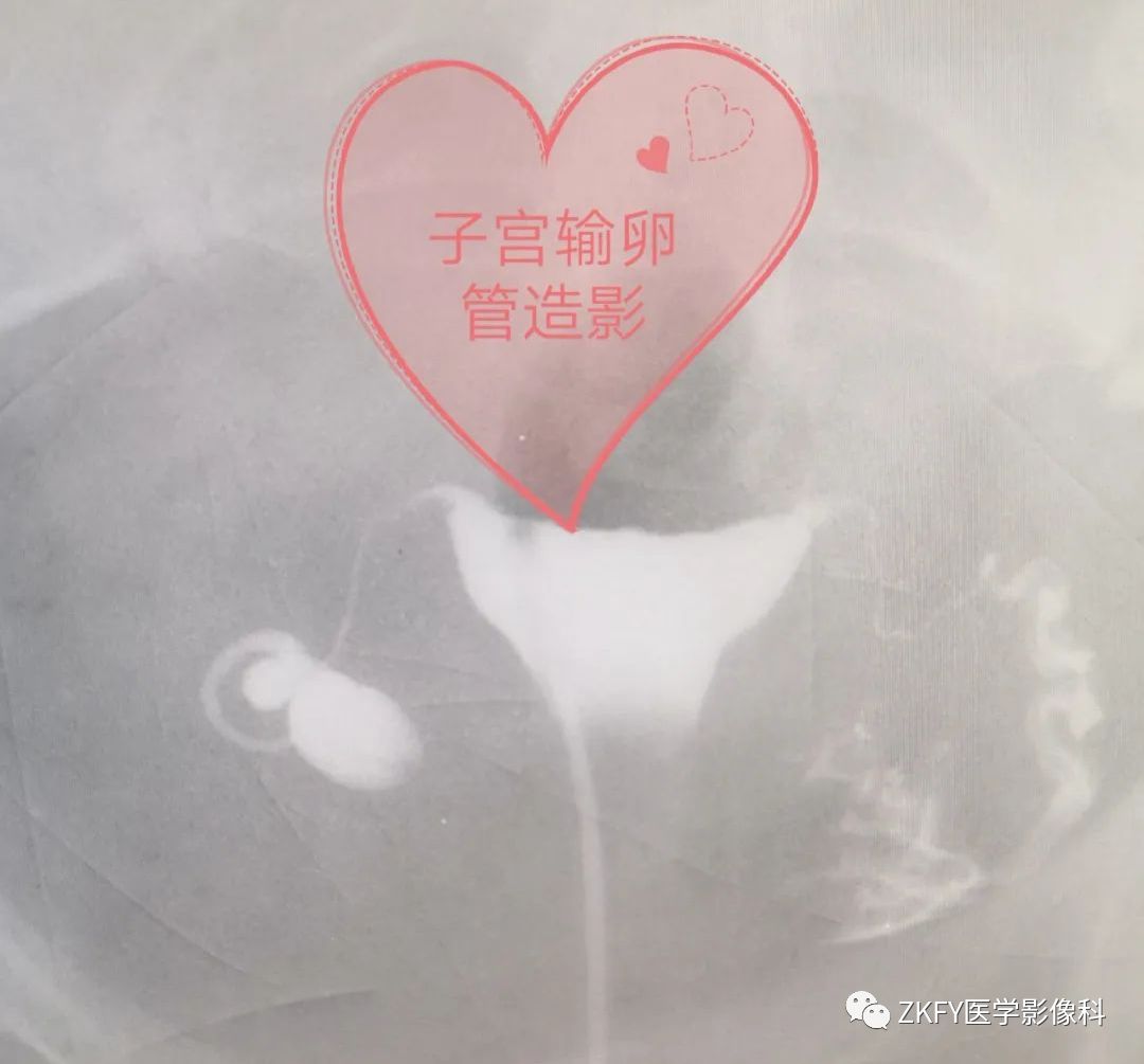 子宫输卵管造影术,子宫输卵管造影术包括哪些项目