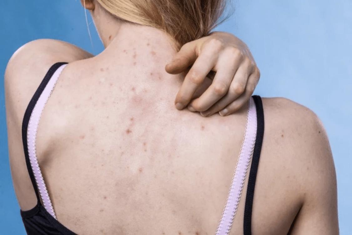 后背长痘不用怕教你战痘小方法,后背长痘痘分哪几种