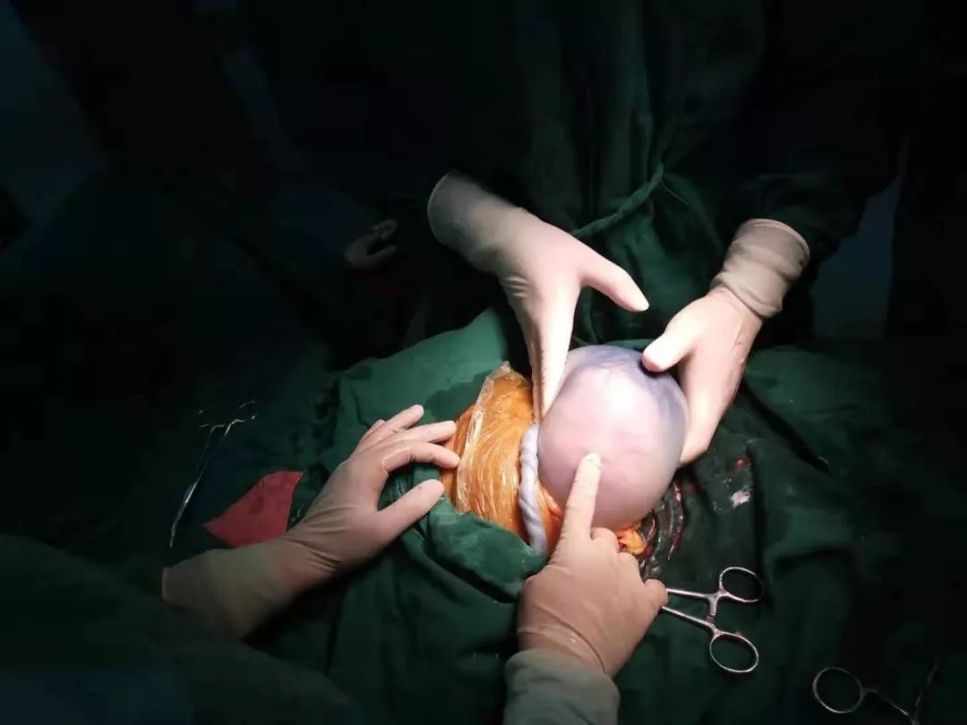 年轻女子怀孕25周产下龙凤胎,长大后的小伶要生宝宝了